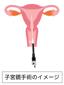 腹腔鏡手術のイメージ